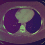 An animated GIF of my CT scan going from chest to legs