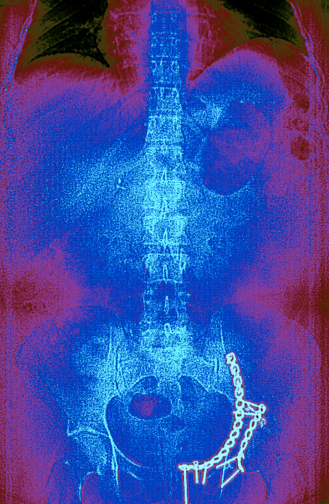 My pelvis and abdomen via CT Scan Note the metal link in my left pelvis.